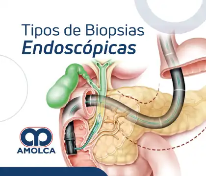 Tipos de Biopsias Endoscópicas