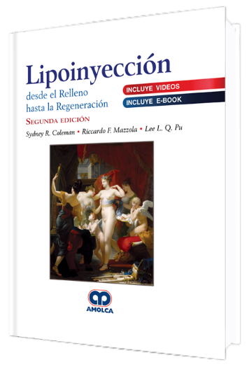 Lipoinyección Desde el Relleno hasta la Regeneración 2 Edición