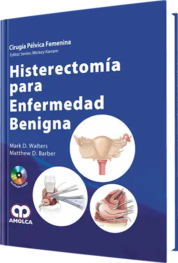 Histerectomía para Enfermedad Benigna