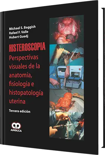 Histeroscopia. 3 edición