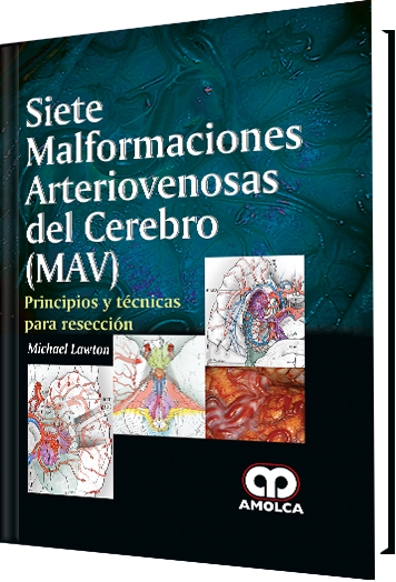 Siete Malformaciones Arteriovenosas del Cerebro (MAV)