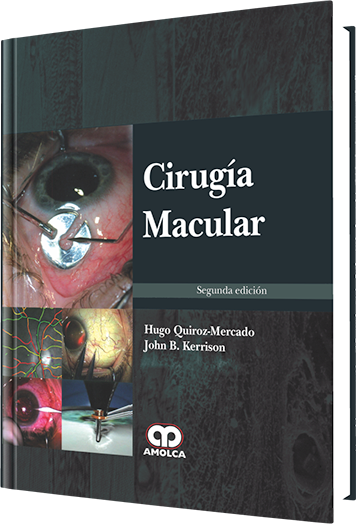 Cirugía Macular. 2 Edición