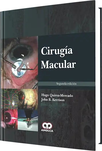 Cirugía Macular. 2 edición