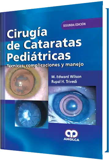 Cirugía de Cataratas Pediátricas. 2 edición