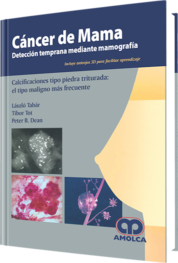 Cáncer de Mama Detección Temprana Mediante Mamografía