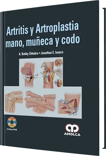 Artritis y Artroplastia - Mano, Muñeca y Codo