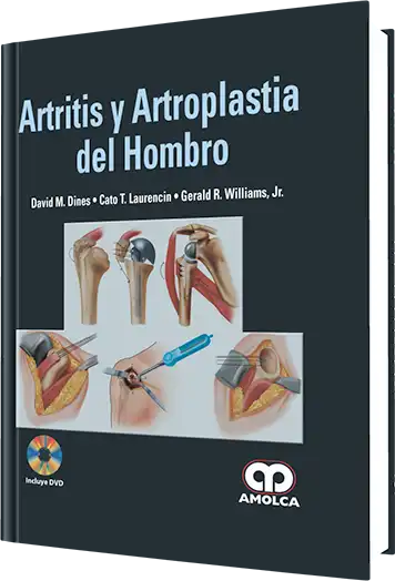 Artritis y Artroplastia del Hombro
