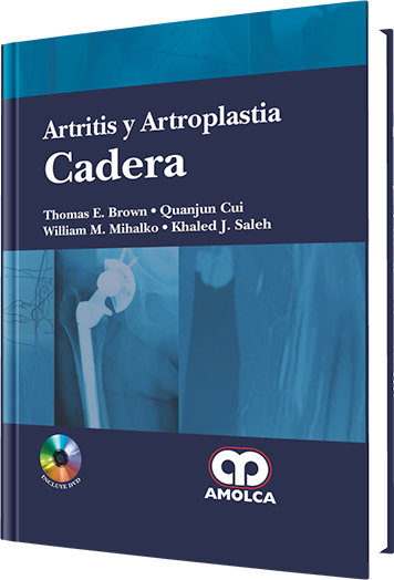 Artritis y Artroplastia. Cadera