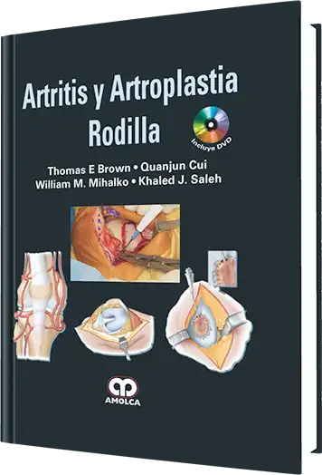 Artritis y Artroplastia. Rodilla