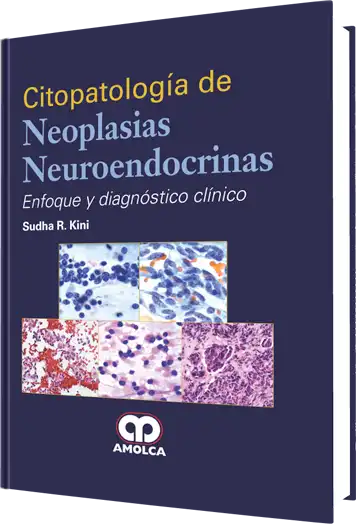Citopatología de Neoplasias Neuroendocrinas