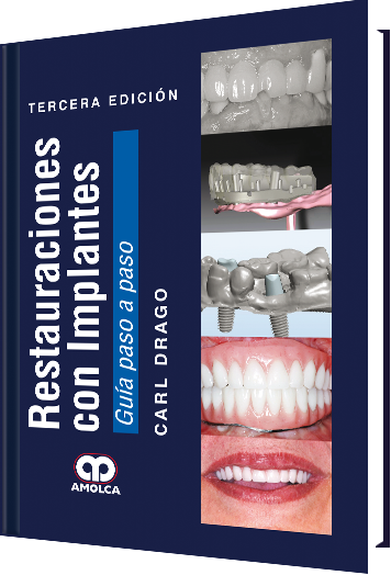 Restauraciones con Implantes. Guía Paso a Paso. 3 Edición
