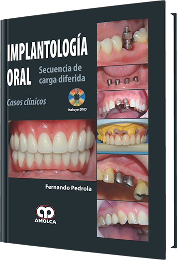 Implantología Oral