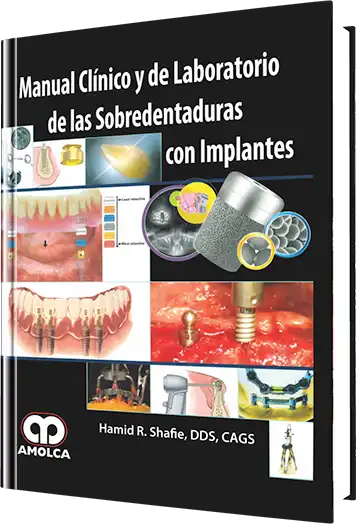 Manual Clínico y de Laboratorio de las Sobredentaduras con Implantes