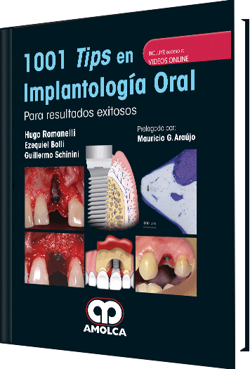 1001 Tips en Implantología Oral