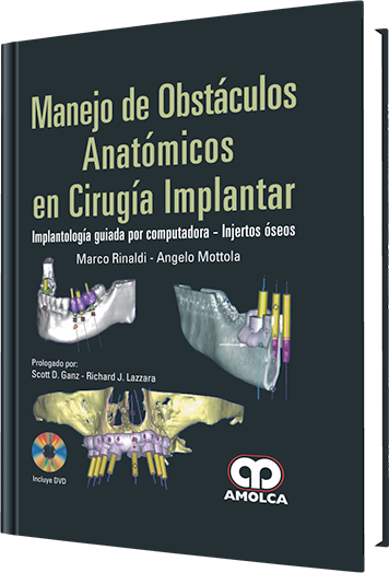 Manejo de Obstáculos Anatómicos en Cirugía Implantar
