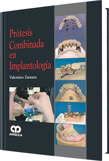 Prótesis Combinada en Implantología