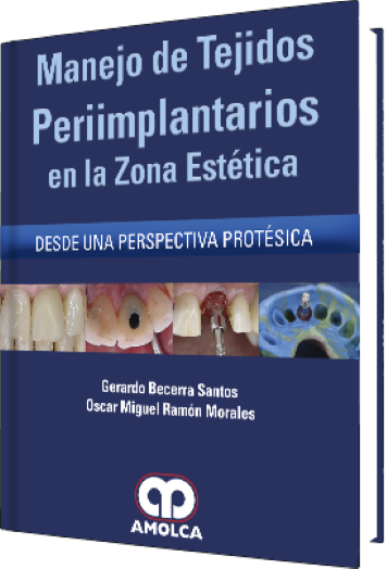 Manejo de Tejidos Periimplantarios en la Zona Estética