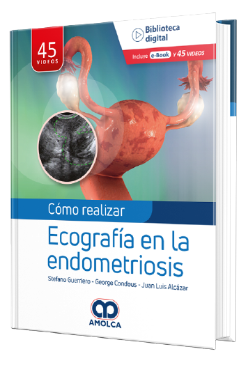 Cómo realizar Ecografía en la endometriosis